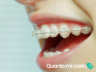Quanto costa l'apparecchio dentale?
